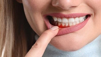 5 نصائح للوقاية من حكة اللثة
