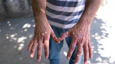 تسجيل 28 حالة إصابة بجدري القرود بكوت ديفوار