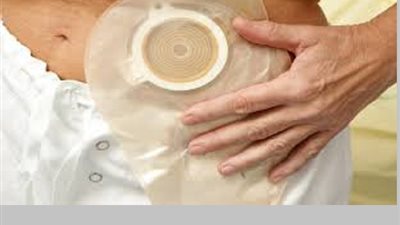 أثر تركيب جهاز الكولوستومي على طهارة المريض