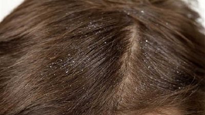طرق علاج مشكلة قمل الرأس