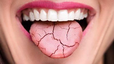 نصائح لعلاج جفاف الفم ..أبرزها تجنب الكافيين