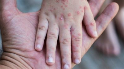 غينيا تسجل أول حالة إصابة مؤكدة بجدرى القرود