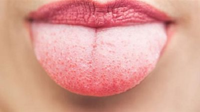 ماذا يعني ظهور طبقة بيضاء على اللسان ؟ طبيبة تجيب