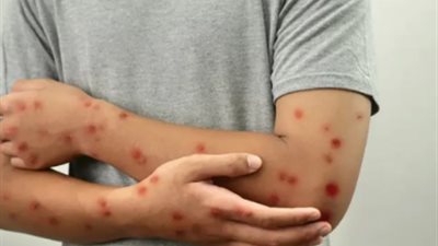 طرق الوقاية من فيروس جدري القرود