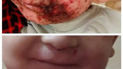 فريق طبى لتشخيص حالة طفل بحميات بنى سويف