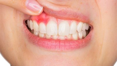سوء تنظيف الأسنان .. أبرز أسباب نزيف اللثة