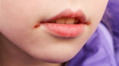 علماء: فيروس الهربس البسيط يمكن أن يتسلل إلى المخ والعين