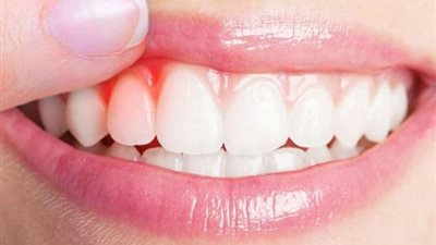 6 علامات تشير للإصابة بأمراض اللثة