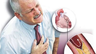 4 نصائح هامة لمرضى ضغط الدم والكوليسترول والشريان التاجي