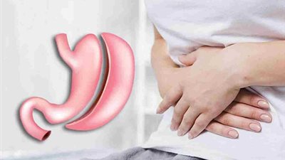 أضرار عمليات تكميم المعدة على المدى القريب والبعيد .. تعرف عليها