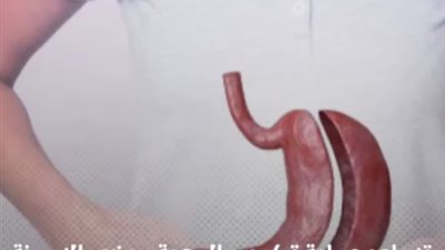 فيديو .. أضرار وفوائد عمليات تكميم المعدة