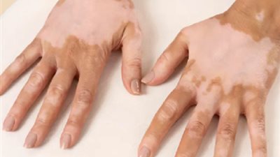 نوع توابل شهيرة تحمى من أخطر الأمراض