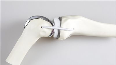 ابتكار قوالب خاصة لزراعة أجسام شبه كروية لمفاصل الركبة