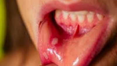 طرق طبيعية لتخفيف قرحة الفم المؤلمة