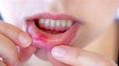 كيف يحدث سرطان الفم ؟ دراسة تكشف