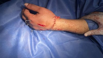 نجاح جراحة زراعة يد مبتورة لمريض بالقصر العيني