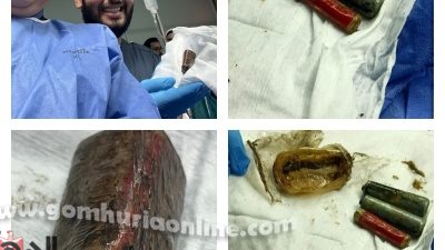 معجزة طبية بالمنوفية: استخراج حجارة ريموت من معدة مريض بدون جراحة