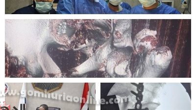 نجاح أول جراحة معقدة بمفصل الحوض في مستشفى بركة السبع بالمنوفية