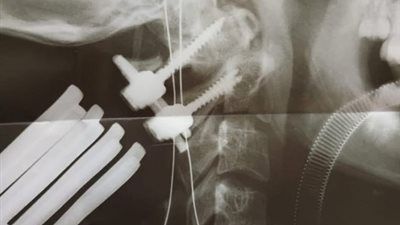 إنقاذ فتاة من الاصابة بالشلل الرباعي بعد اصابتهابحادث في الدقهلية