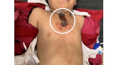 مستشفى جامعة سوهاج تنجح في إنقاذ طفل تعرض لطعنة نافذة بالقلب