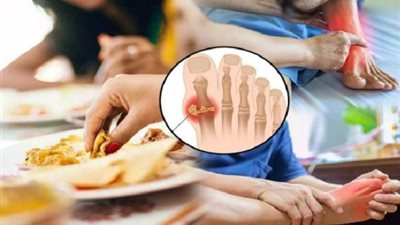 حمض اليوريك .. أطعمة ومشروبات تزيد من مخاطره