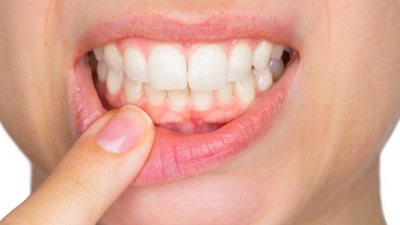 صدق أو لا تصدق: اهمال الأسنان خطر على القلب