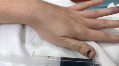 لهذا السبب.. تحول لون دماء فتاة إلى الأزرق