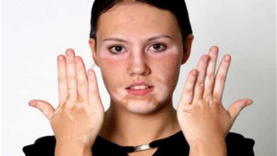 4 أسباب تعرضك لمرض البهاق.. أبرزها 