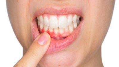 اسباب تورم اللثة.. وأسهل طريق لعلاجه