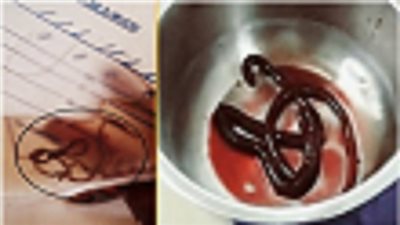 دودة عملاقة تسد كلية رجل هندي .. وتمنعه من التبول ..!