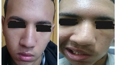 فريق طبي بجامعة أسيوط يعيد الأمل لشاب بعد إصابته بطلق ناري