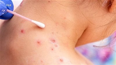 وباء الحصبة ينتشر في إسرائيل بوتيرة متسارعة