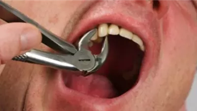 طبيبة أسنان تزوج عليها زوجها فانتقمت بخلع أسنانه..ما حكم ذلك؟