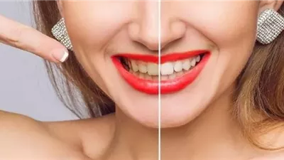 5 أطعمة ومشروبات يومية تسبب اصفرار الأسنان حتى بعد التجميل