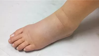 سبب تورم اليدين والقدمين..الوزن أم احتباس السوائل؟