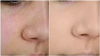 تونرات طبيعية لحل مشكلة المسام الواسعة