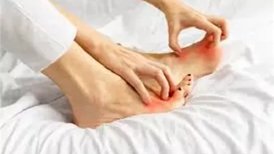 حكة القدمين قد لا تكون عرضًا عابرًا.. تحذير طبي من أمراض خطيرة