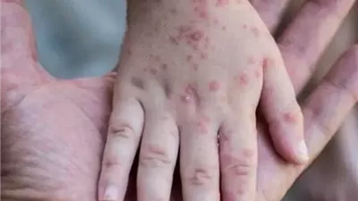 الذكاء الاصطناعي يرسم خريطة لقاح جديد لفيروس جدري القرود