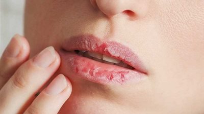 تشقق الشفاه .. متى يكون بسيطًا ومتى يدل على مشكلة صحية؟