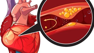 انسداد الشرايين .. الوقاية خير من العلاج