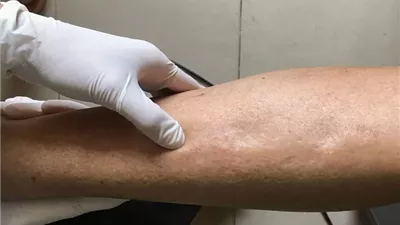 احتباس الماء في الجسم .. الأسباب والأعراض وطرق العلاج الفعّالة