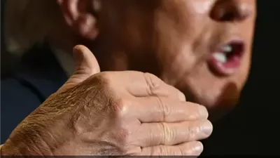 كدمات يد ترامب تثير الجدل.. والرئيس الأميركي يوضح
