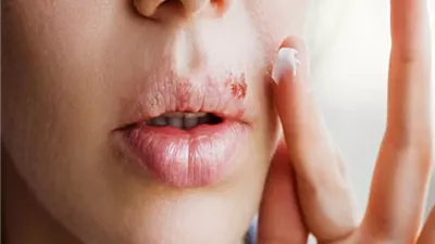 قرحات البرد الجلدية .. الأسباب والأعراض وطرق العلاج الحديثة