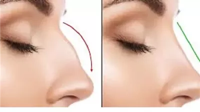 حكم القيام بعملية تجميل في الأنف؟