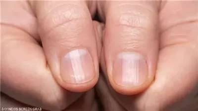 ماذا تخبرك أظافرك عن صحتك؟ علامات صامتة قد تنذر بمشكلات صحية