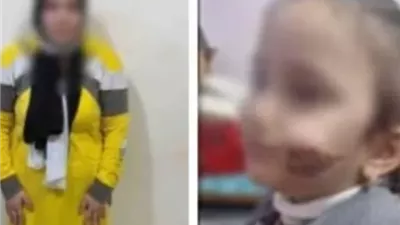 أم استخدمت آداة معدنية ساخنة لتشويه وجه طفلتها