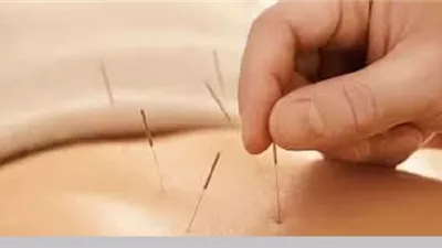 حكم الوخز بالإبر الصينية والقسطرة