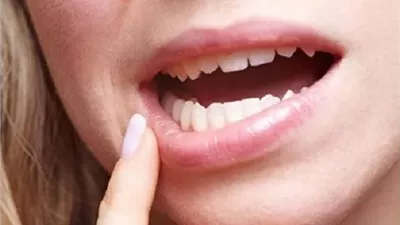 بقع بيضاء أو حمراء في الفم قد تنذر بسرطان الفم