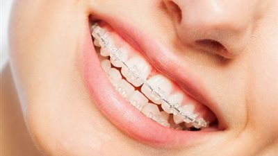 هل يوجد بديل للتقويم؟..طبيب اسنان يجيب