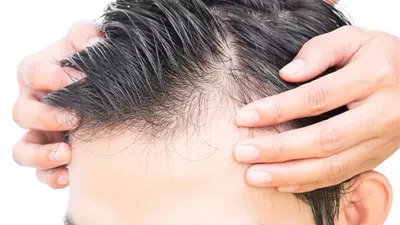 البلازما للشعر .. حل سريع وفعّال لتقليل التساقط